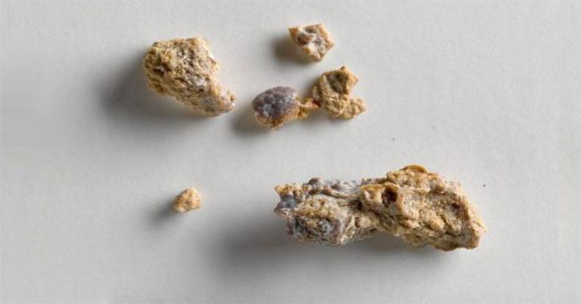 Kidney stones are not frozen but continuously dissolve and develop