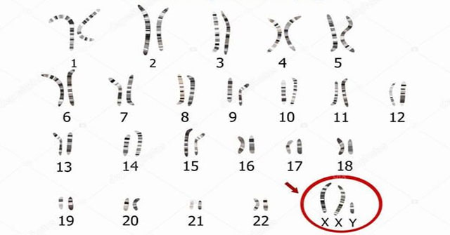 Klinefelter Syndrome - Men carry the female gene