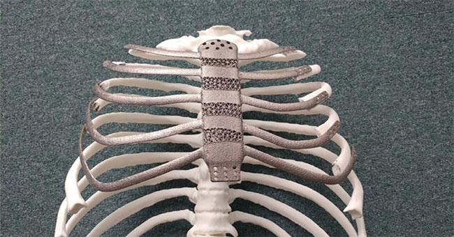 Korea: Artificial breast implant with the first 3D printing technology