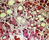 Lack of substance also causes fatty liver