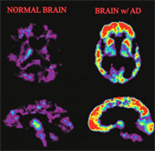 Latest model of Alzheimer's causes