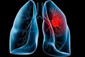 Learn about different types of cancer