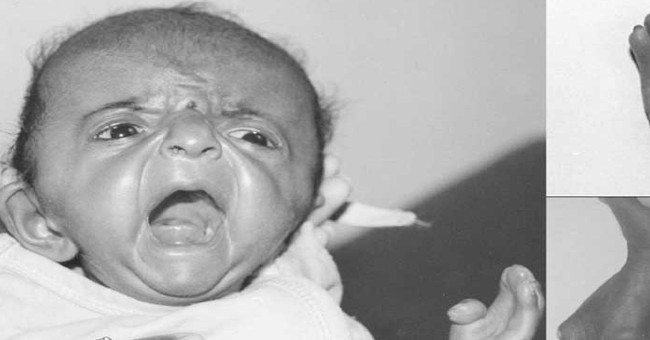 Learn about the rare disease called: Apert Syndrome