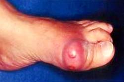 Leprosy: Drinking coffee, reducing the risk of disease
