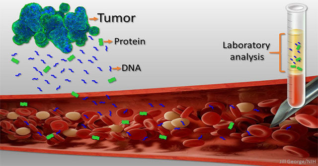 Liquid biopsy: The dream of the world's most prominent oncologist