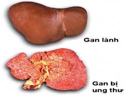 Liver cancer often appears silently