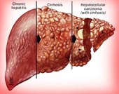 Liver cancer - the disease is easy to die early