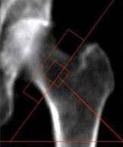 Loss of bone, serious problem threatens astronauts