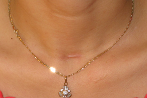 Low invasive thyroid endoscopy, without scarring