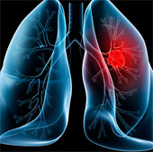 Lung cancer and stages