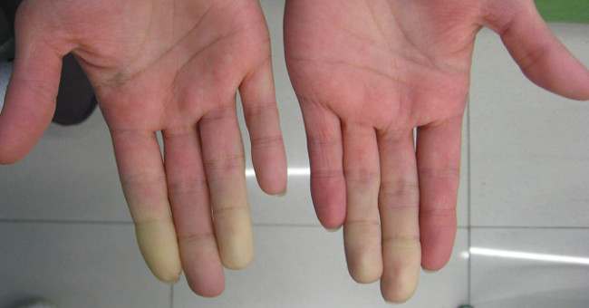 Lupus, a dangerous disease that attacks young women