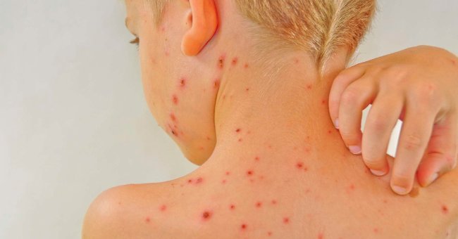 Lupus erythematosus - A dangerous little known disease