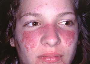 Lupus may explain the difference in the risk of developing sexually transmitted diseases