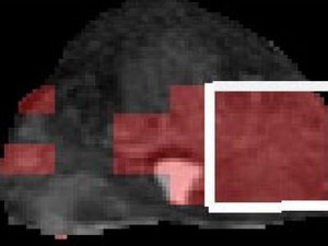 Magnetic resonance imaging finds prostate cancer