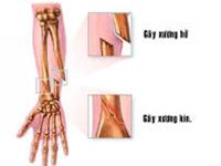 Management of open fractures