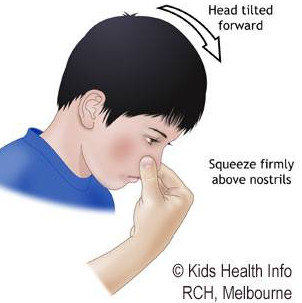 Management when the nose bleeds