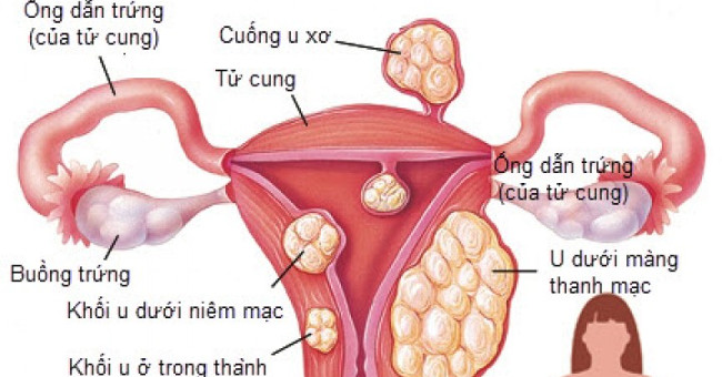 Many women have fibroids without knowing it