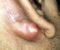 Mastitis in the ear is easy to cause dangerous complications