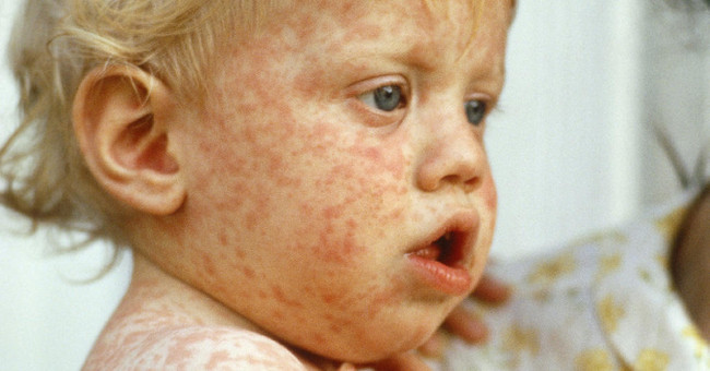 Measles outbreaks spread throughout Europe
