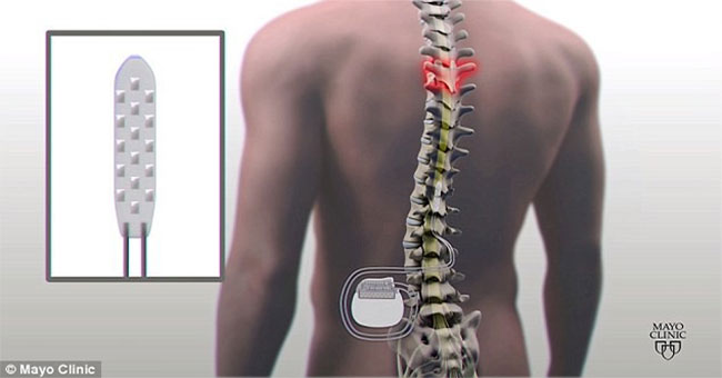 Medical breakthrough: For the first time, paralysis patients can walk