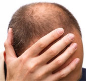 Men are more afraid of baldness than