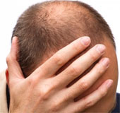 Men with baldness are at risk for coronary artery disease