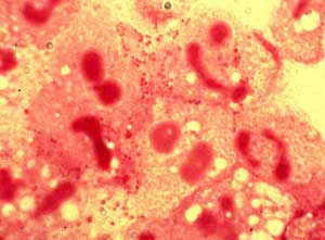 Meningococcal disease and preventive measures