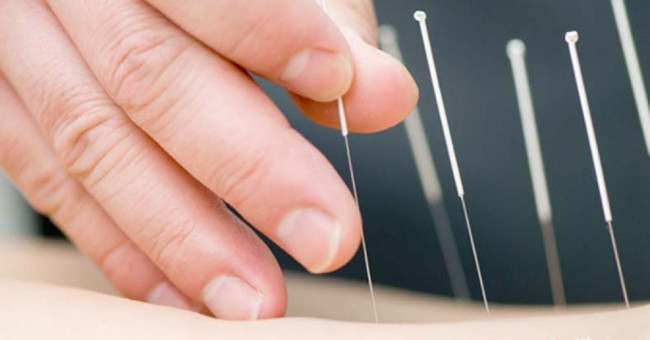 Mercury, acupuncture method to cure many diseases