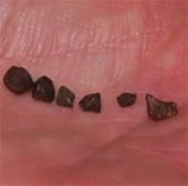Meteors fell on the head of a 7-year-old boy