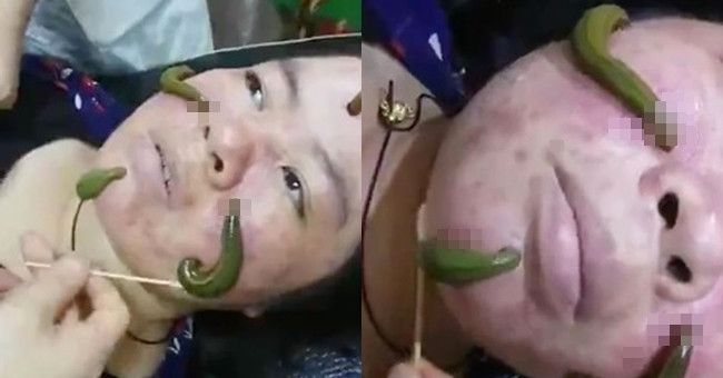 Method of treating acne with leeches in China