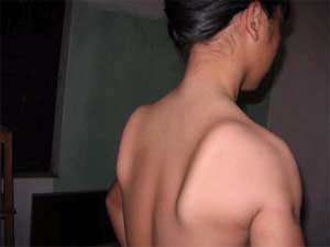 Ministry of Health issued Delta regimen for treatment of muscle atrophy