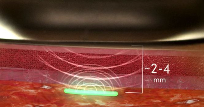 Monitor your health every day with a micro transplant