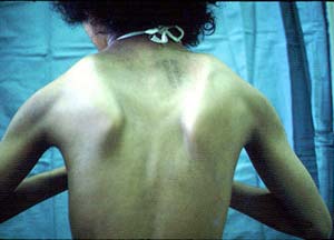 Muscular dystrophy can affect intelligence