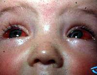 Myopia - How to care for and prevent complications