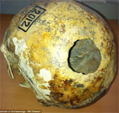 Mysterious skull surgery 2300 years ago