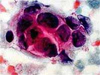 Nano-bombs destroy cancer