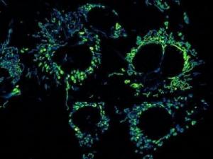 Nanoparticles help kill cancer cells