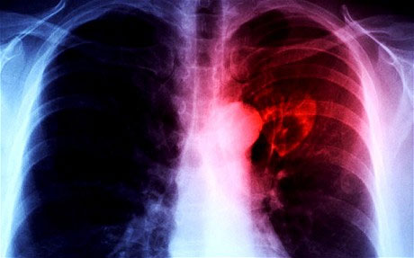 Narrow the heart to prolong life