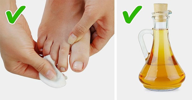 Natural ways to cure malformed toenails stab into flesh