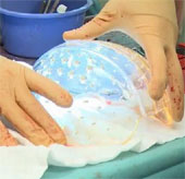Netherlands: Successfully implanted 3D skull for a woman