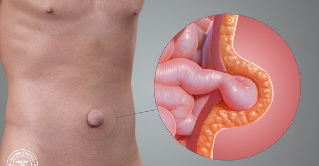 Never let your belly encounter this condition