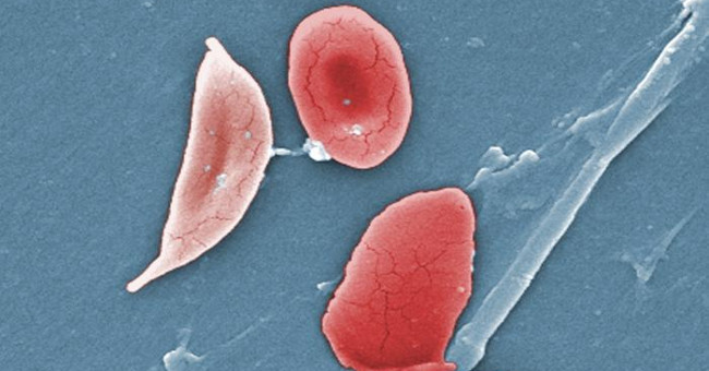 New breakthrough in the treatment of sickle cell disease