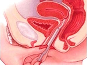 New compounds that kill sperm