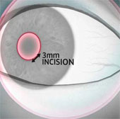 New contact lenses technology implanted directly into the eye