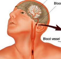 New drug against stroke