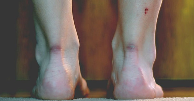 New finding: 'Transplanting hair' into the wound for permanent scar removal