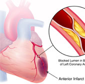 New hope for patients with heart attack