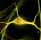 New hope for patients with post-traumatic psychosis