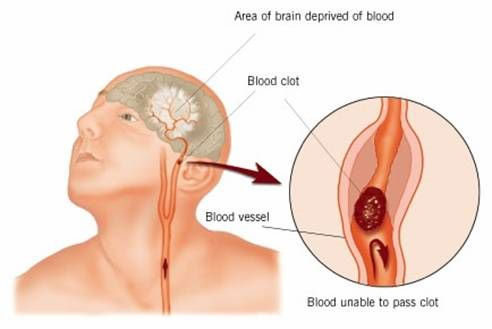 New hope for patients with stroke