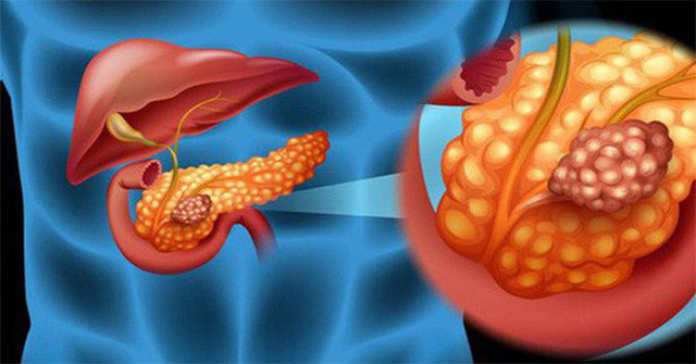 New hope for people with pancreatic cancer